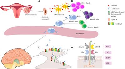 Ovarian Teratoma-Related Paraneoplastic Neurological Syndromes